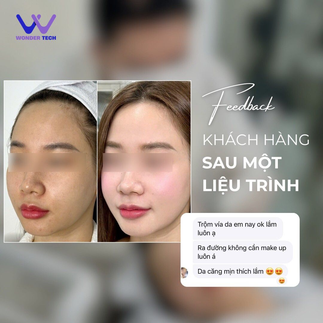 Công nghệ Vi kim RF NEEDLE VACUUM (4) Ảnh minh họa Công nghệ Vi kim RF NEEDLE VACUUM